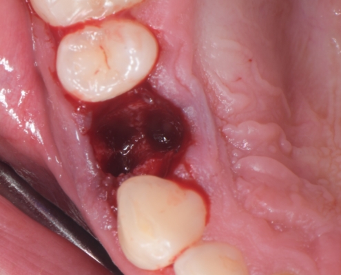 Slika 1. Očišćena i pripremljena postekstrakcijska alveola. (Preuzeto s dopuštenjem autora: doc. dr. sc. Marko Vuletić)