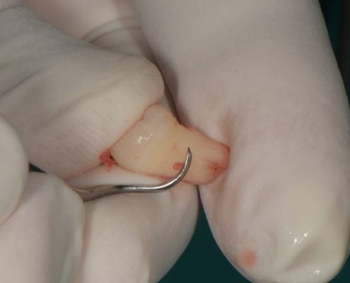 Slika 2. Mehaničko čišćenje i priprema zuba. (Preuzeto s dopuštenjem autora: doc. dr. sc. Marko Vuletić)