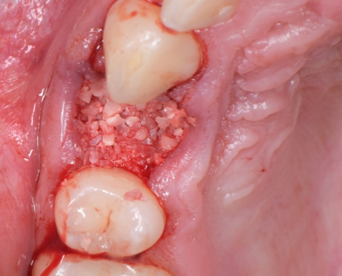 Slika 7. Postavljen dentinski graft u postekstrakcijsku alveolu. (Preuzeto s dopuštenjem autora: doc. dr. sc. Marko Vuletić)