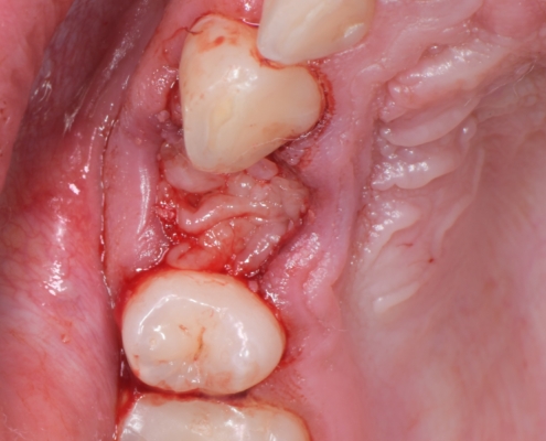 Slika 8. Prekrivanje dentiskog grafta PRGF fibrinskom mebranom. (Preuzeto s dopuštenjem autora: doc. dr. sc. Marko Vuletić)