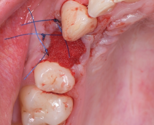 Slika 9. Prekrivanje grafta kolagenskom spužvom i pozicijski šavovi. (Preuzeto s dopuštenjem autora: doc. dr. sc. Marko Vuletić)